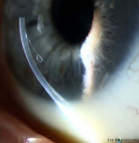 Cornea Header