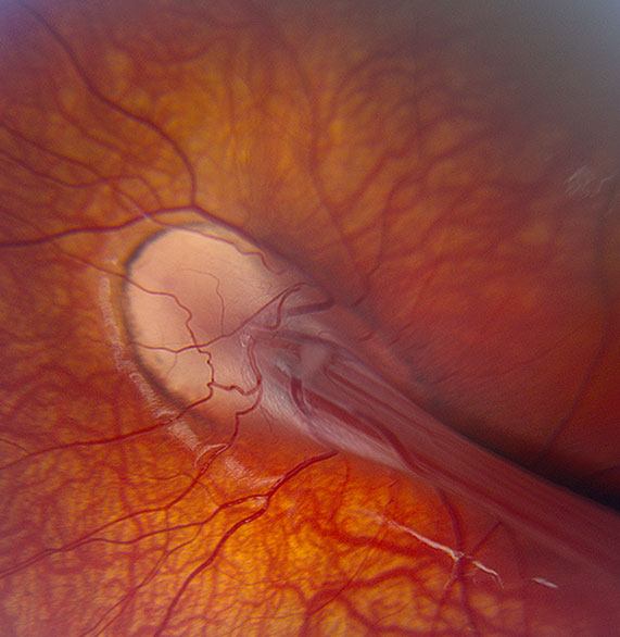 Inherited Retinal Diseases Header