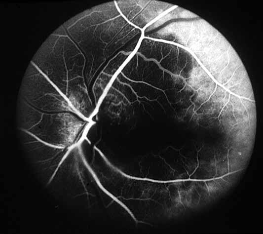 Left eye with arteritic AION, showing choroidal filling defects (dark areas) during the early stages of AION