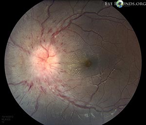 Idiopathic Intracranial Hypertension