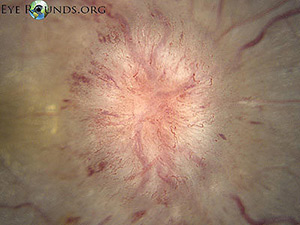 Idiopathic Intracranial Hypertension