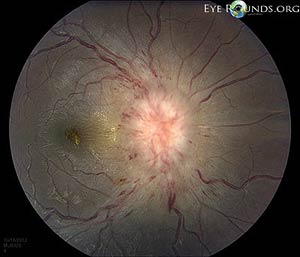 Idiopathic Intracranial Hypertension