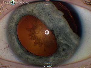 Iridodialysis and traumatic cataract after firecracker injury