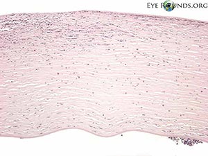 Acanthamoeba keratitis