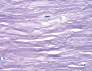 Acanthamoeba keratitis