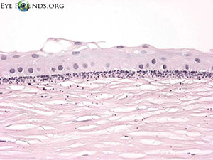 Band Keratopathy