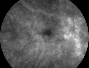 Birdshot choroiretinopathy, fluorescein angiography