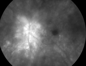 Birdshot choroiretinopathy, fluorescein angiography