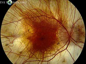 Choroideremia, right eye