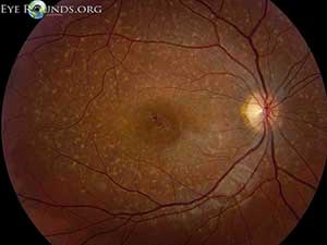 Stargardt Disease, right eye