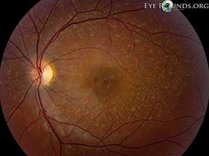 Stargardt Disease, left eye