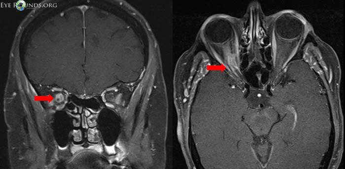 MRI images