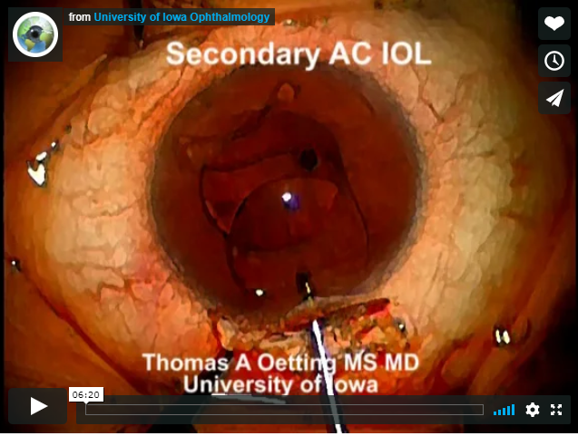 ACIOl Suregery Related Article