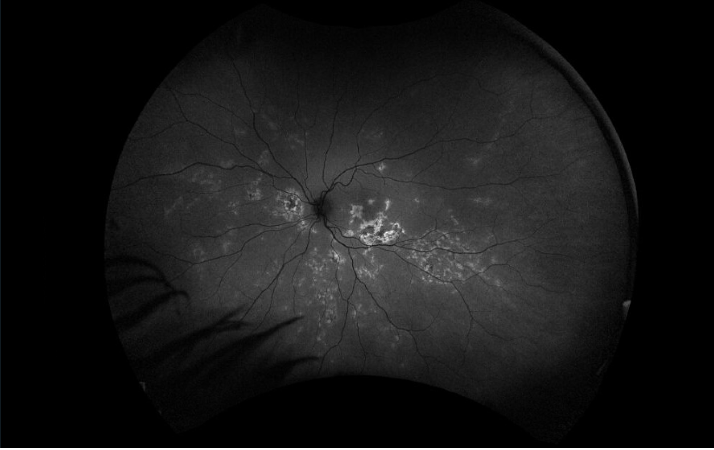 Fundus autofluorescence, left eye. There are multiple patches of hyperautofluorescence with granular hypoautofluorescence located in the macula and midperiphery.