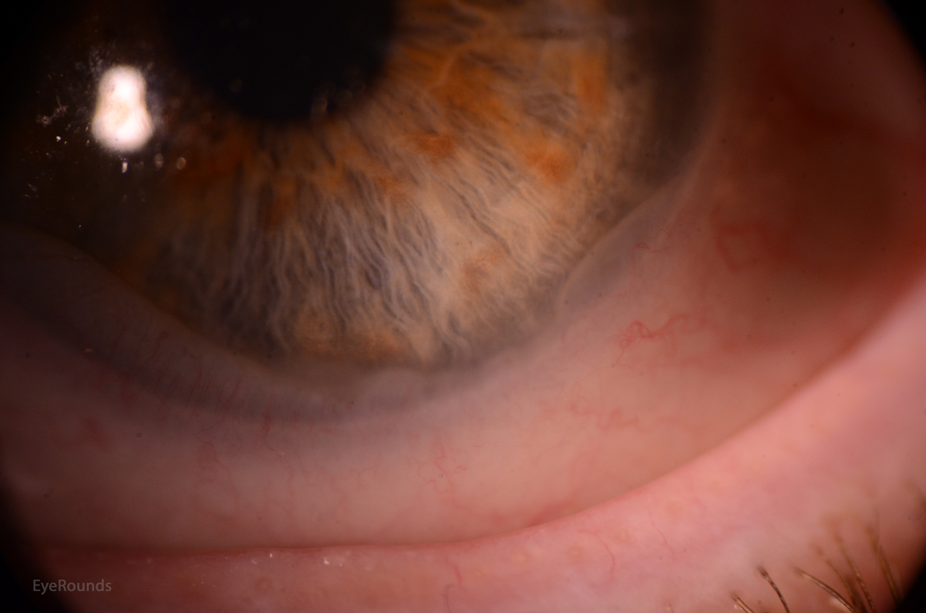 wavy white folds at the peripheral cornea