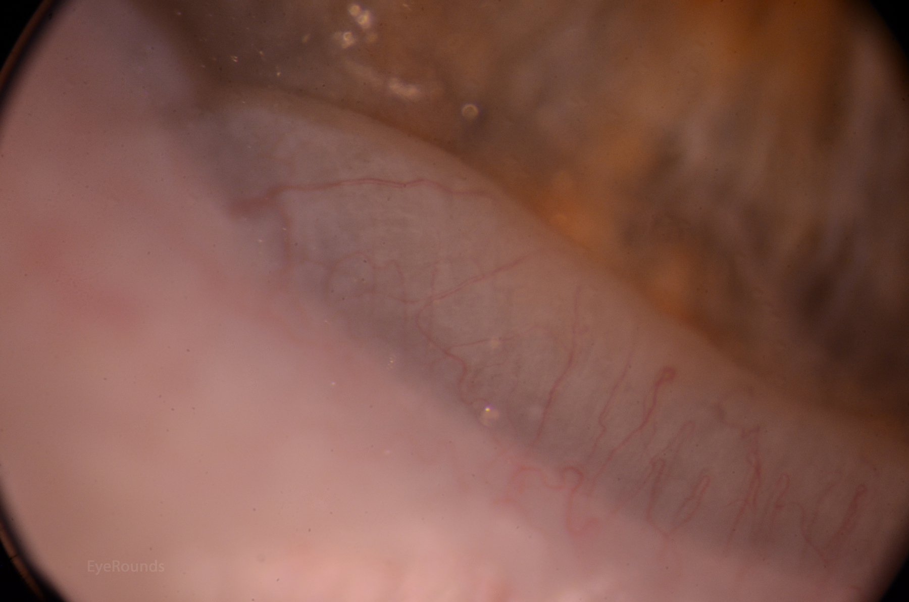 wavy white folds at the peripheral cornea zoomed