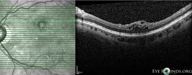 OCT OS: scant ERM remnants nasal to the fovea; thinning temporal in areas of prior membrane peeling.