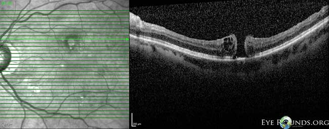 OCT OS: scant ERM remnants nasal to the fovea; thinning temporal in areas of prior membrane peeling.