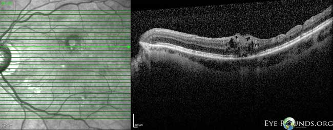 OCT OS: scant ERM remnants nasal to the fovea; thinning temporal in areas of prior membrane peeling.