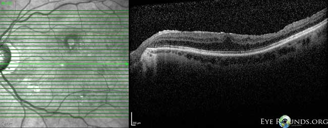OCT OS: scant ERM remnants nasal to the fovea; thinning temporal in areas of prior membrane peeling.