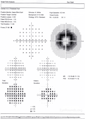 Humphrey Visual Field, right eye