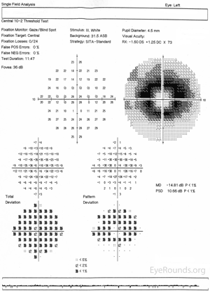 Humphrey Visual Field, left eye