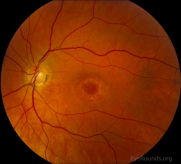 left eye. melanin in the retinal pigmented epithelium (RPE)
