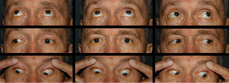 Branch Retinal Artery Occlusion