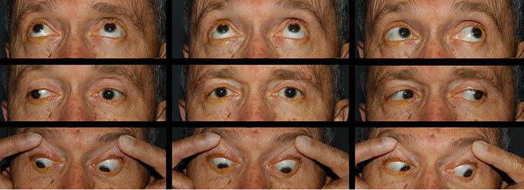 Branch Retinal Artery Occlusion