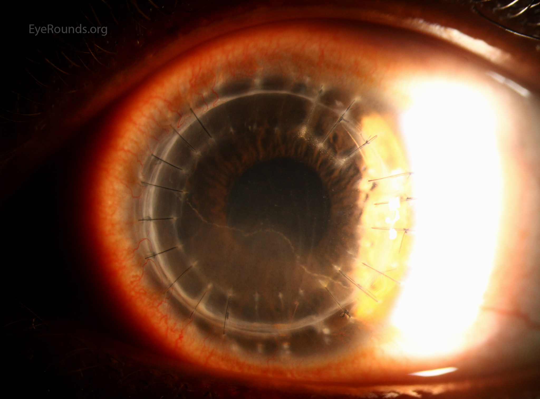 horizontal endothelial linear opacitiy which is more distinct with sclerotic scatter lighting