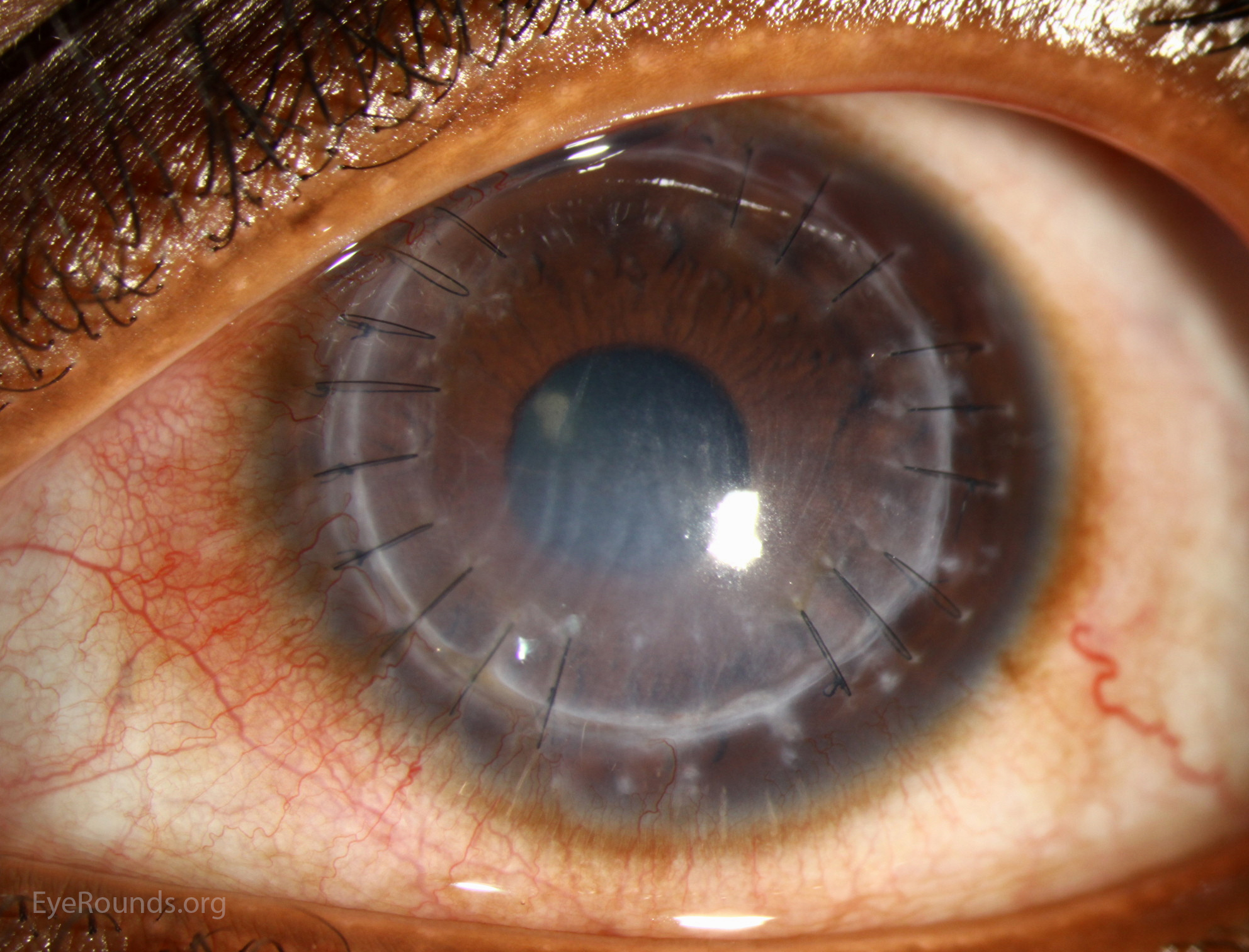 opacity is a rejection line consistent of white blood cells on the endothlium and is also known as a Khodadoust line