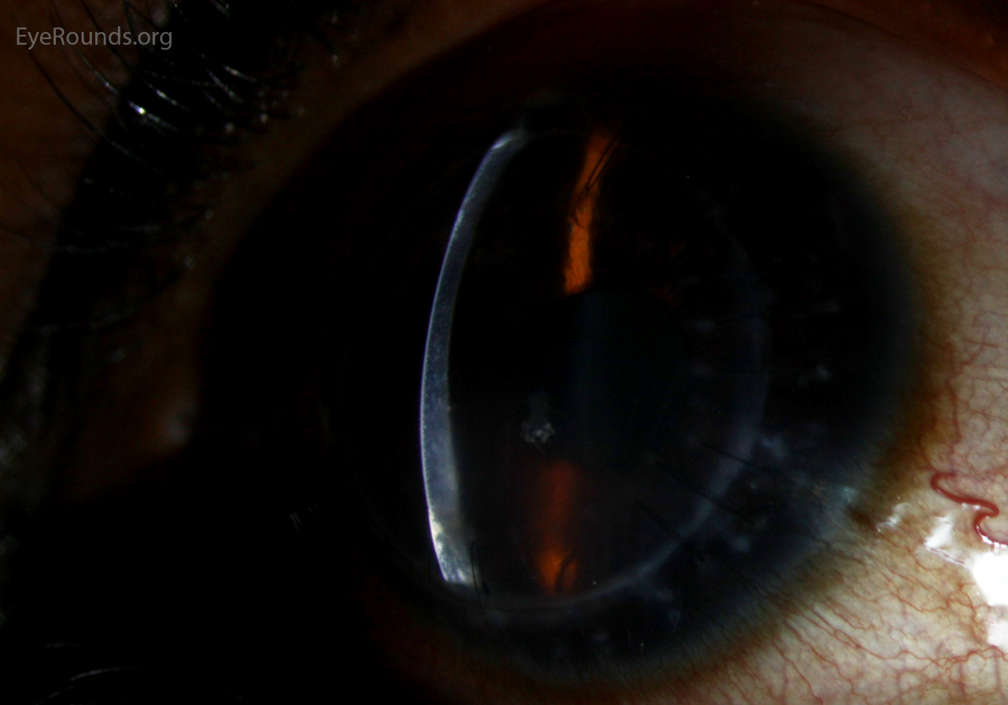 slit lamp of Khodadoust line