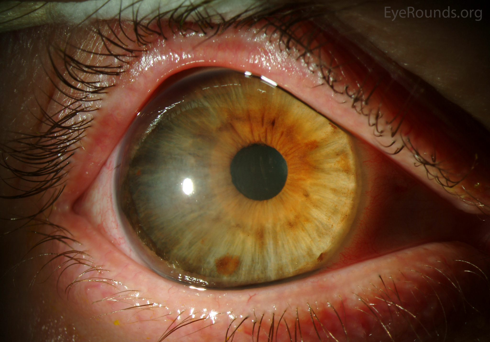 Megalocornea large