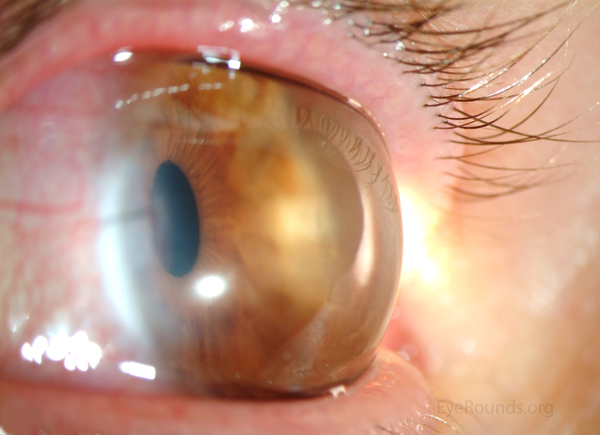 Megalocornea oblique