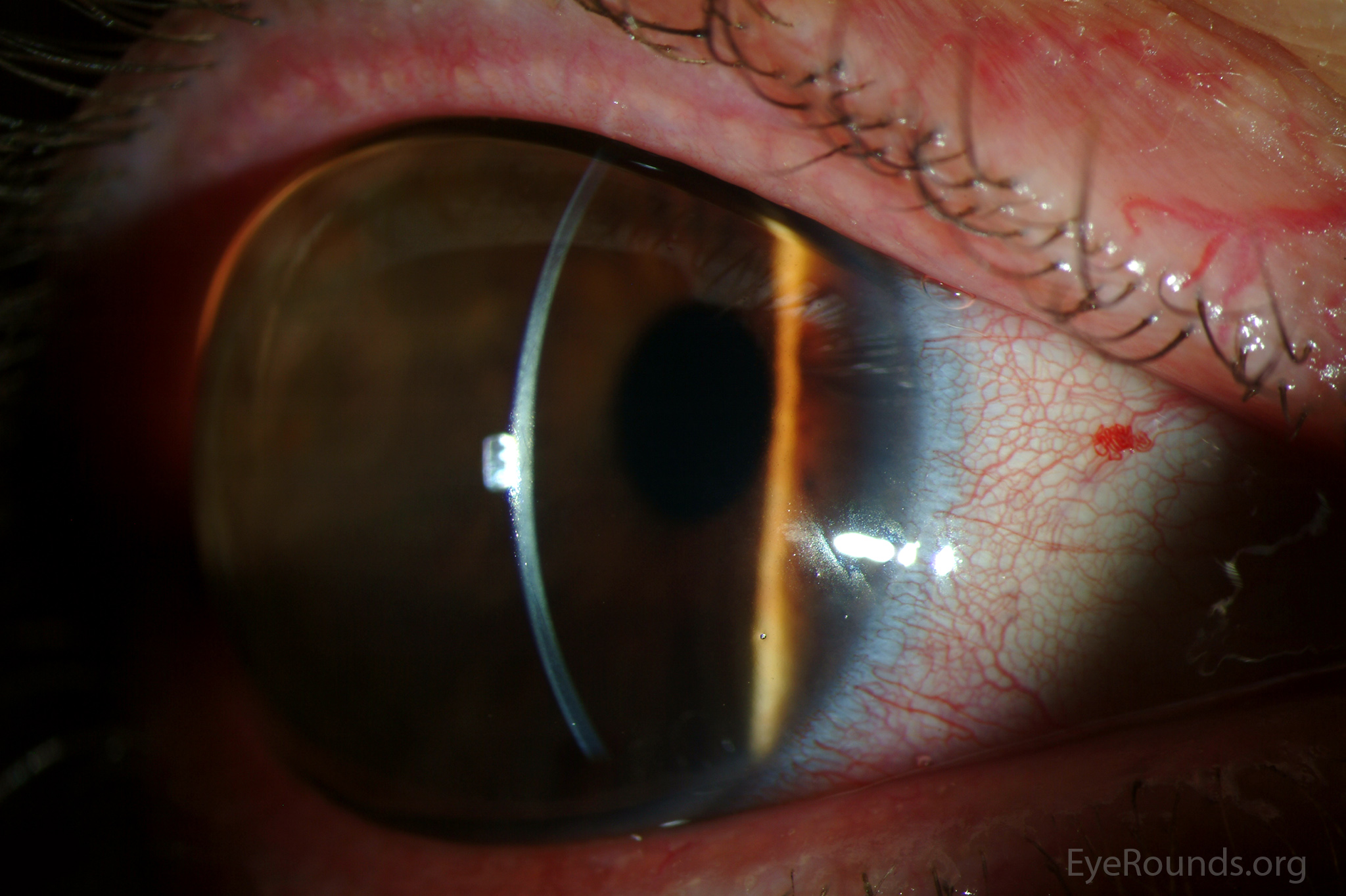 Megalocornea slit lamp large
