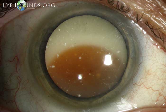 Angle closure glaucoma