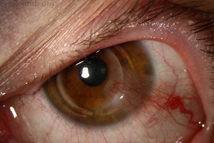 advancement of conjunctiva onto the corneal surface
