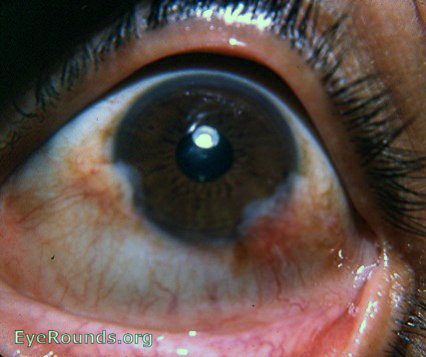 pseudopterygium / Salzmann's nodular corneal degeneration