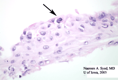 Acanthamoeba Keratitis