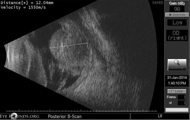 related entry - Choroidal Detachment: Hemorrhagic, Appositional/Kissing