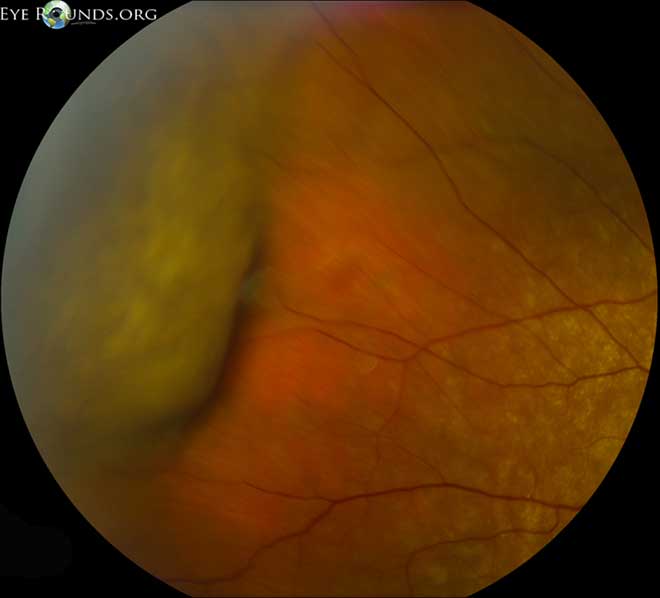 related entry - Choroidal Detachment: Hemorrhagic, Non-Appositional