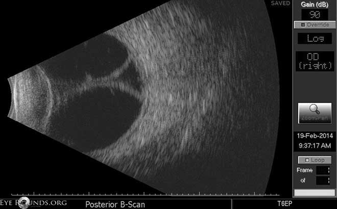 Atlas Entry - Choroidal Detachment: Serous, Appositional/Kissing