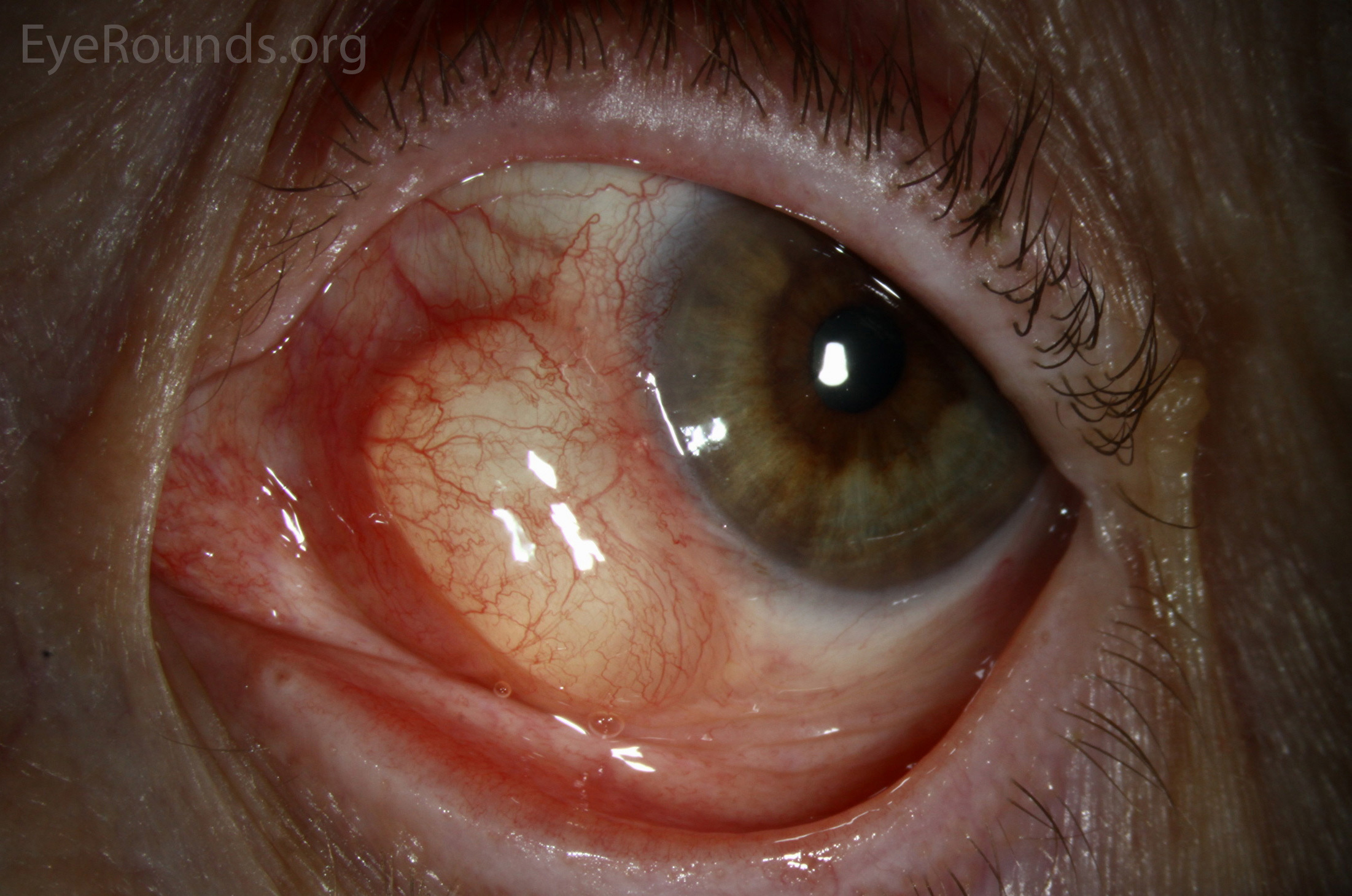 Epithelial inclusion cysts