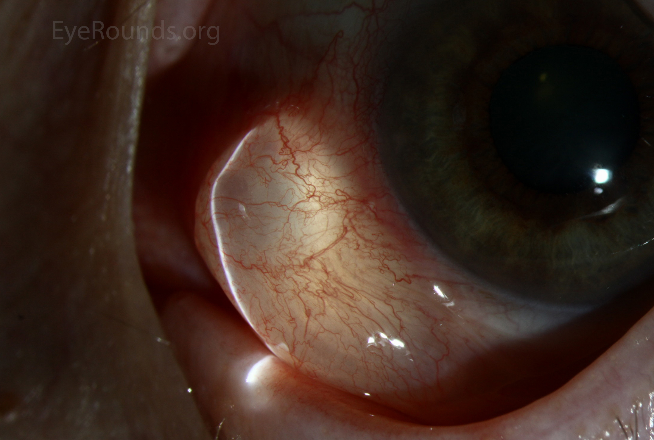 Epithelial inclusion cysts zoom - slit lamp