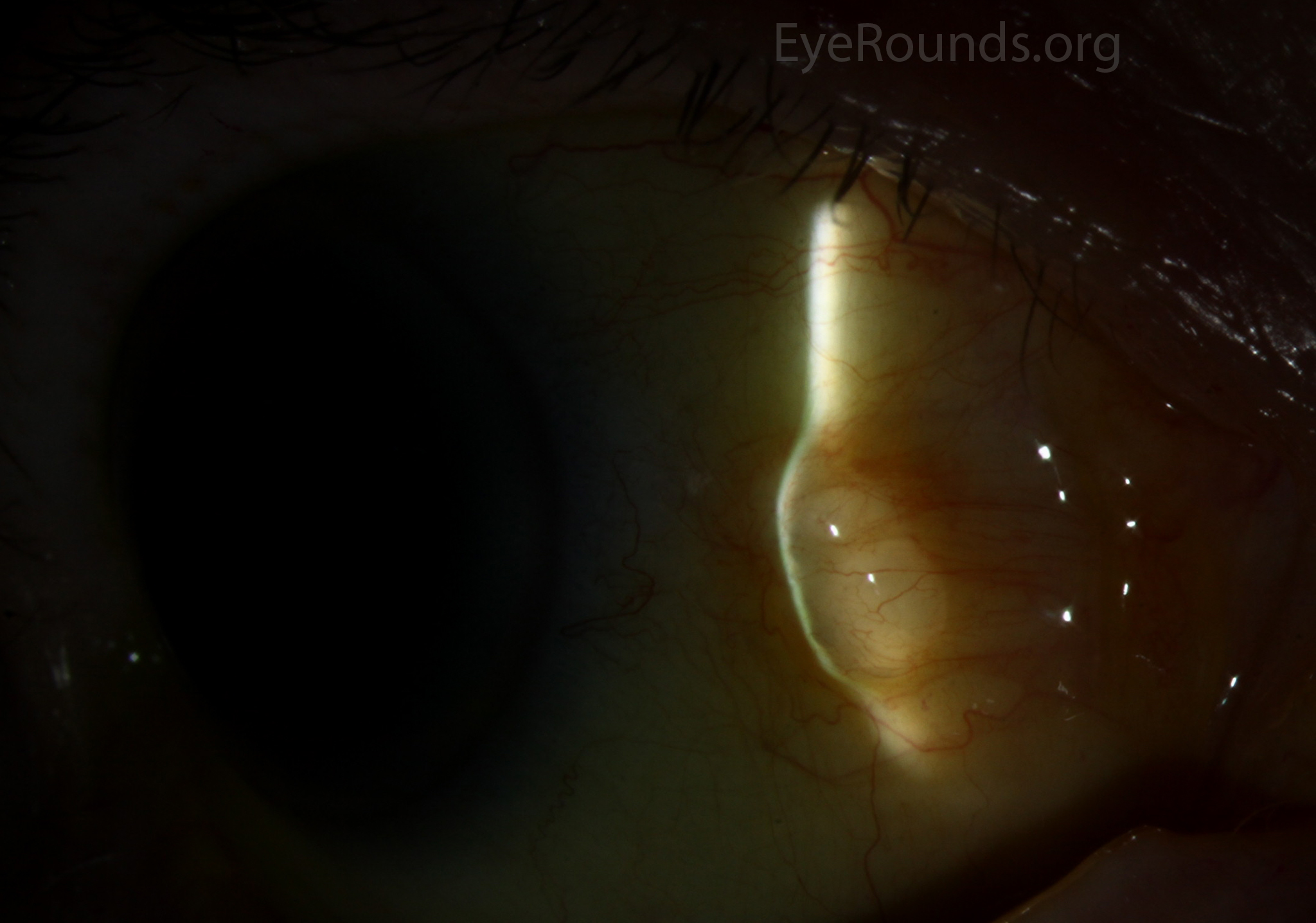Epithelial inclusion cysts zoom - slit lamp