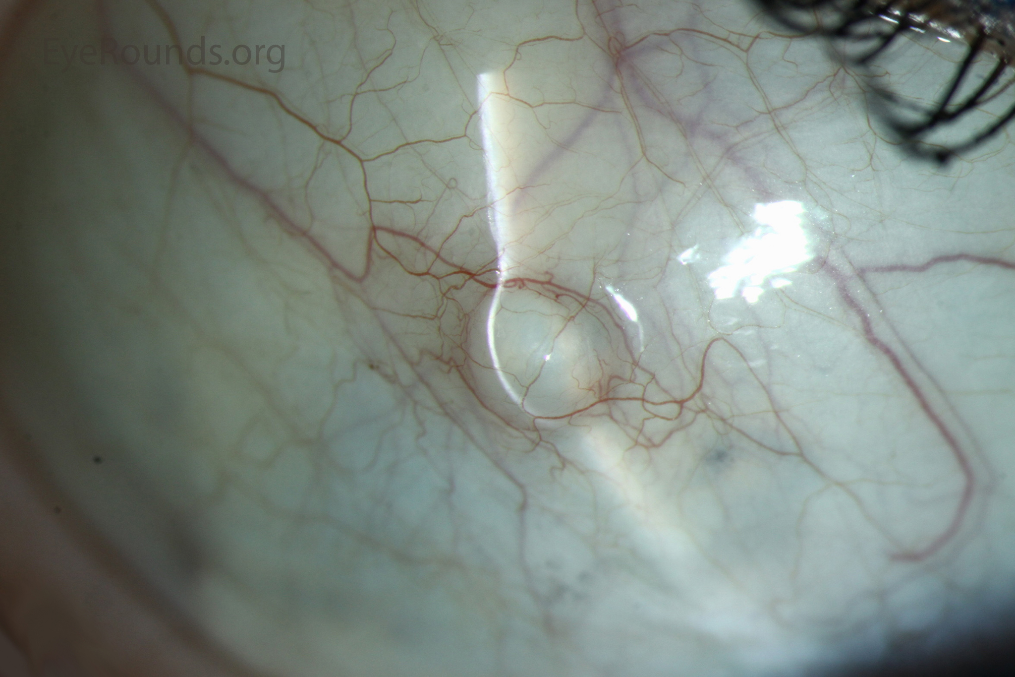 Epithelial inclusion cysts zoom - slit lamp