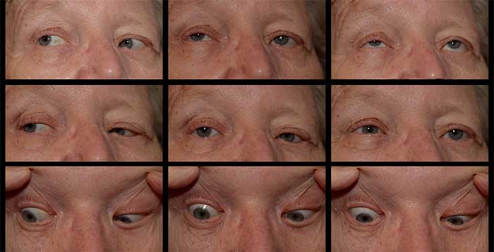 Glaucomflecken