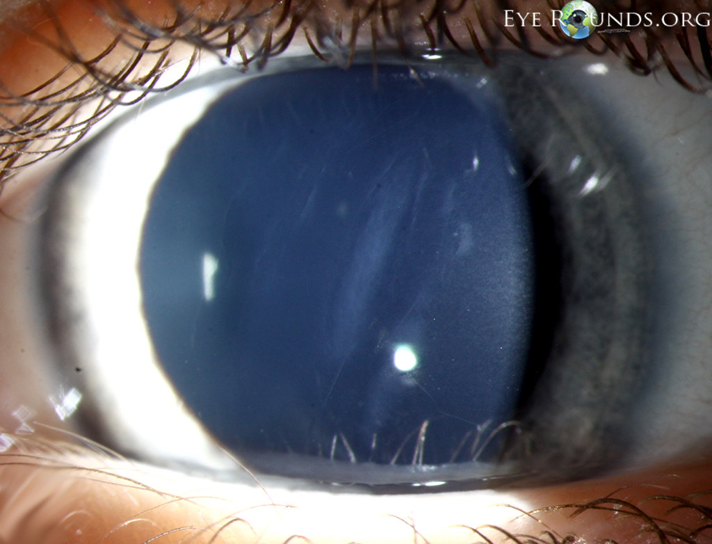 obliquely-oriented ruptures in Descemet's membrane resulting from forceps injury in a 4-year-old girl