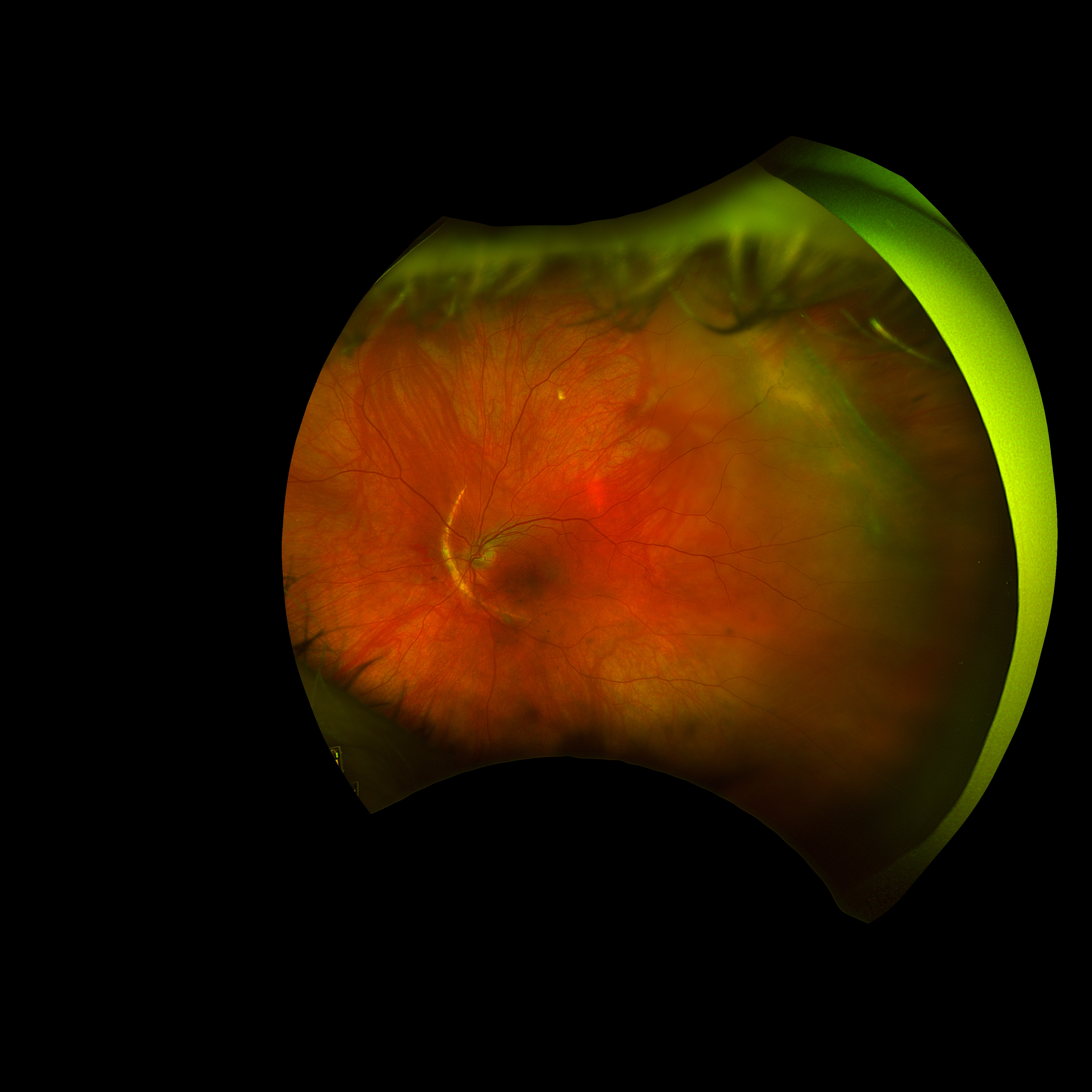  Optos pseudocolor fundus photograph of a left eye demonstrating a large, arcuate choroidal rupture just nasal to the optic disc, with an associated macula-sparing rhegmatogenous retinal detachment 