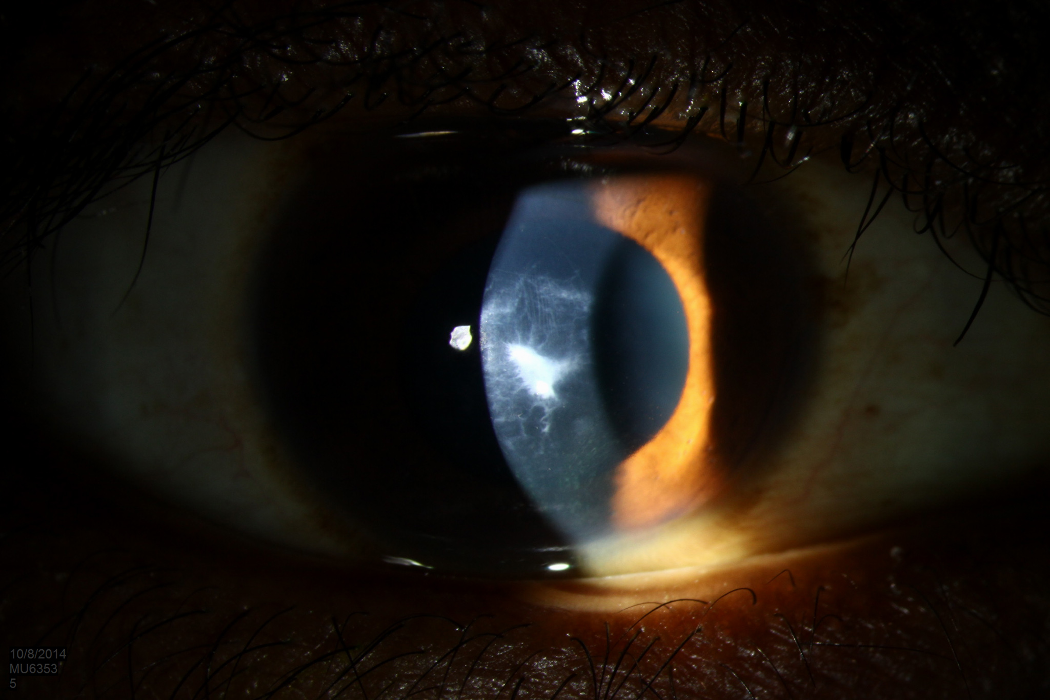 Keratoconus